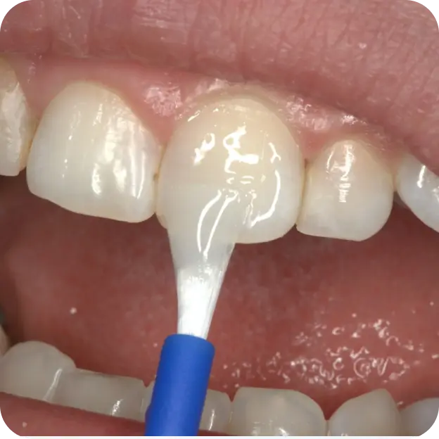 Fluoride Varnish